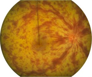 occlusion veine centrale de retine