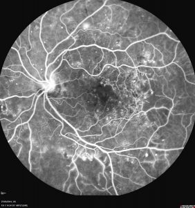 retinopathiediabétique